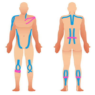kinesio-taping